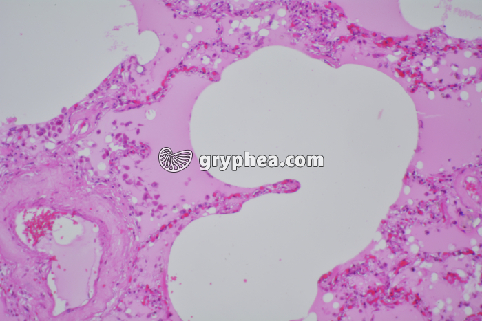 Poumon de fumeur x40 - gryphea.org